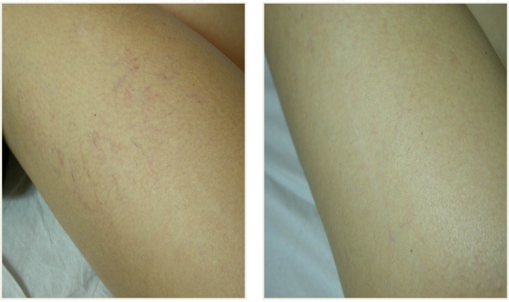 Лазерное удаление звездочек на ноге